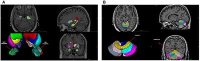 Linking Early Life Hypothalamic–Pituitary–Adrenal Axis Functioning, Brain Asymmetries, and Personality Traits in Dyslexia: An Informative Case Study